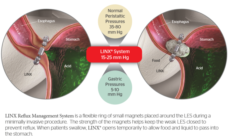 LINX Mechanism of Action Dynamic Augmentation